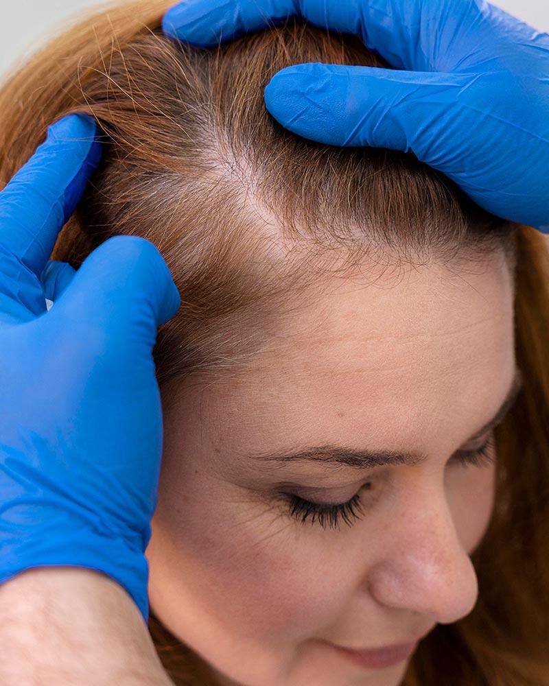 Alopecia Androgenética ou Calvície Feminina no Leblon - Rio de Janeiro - RJ.