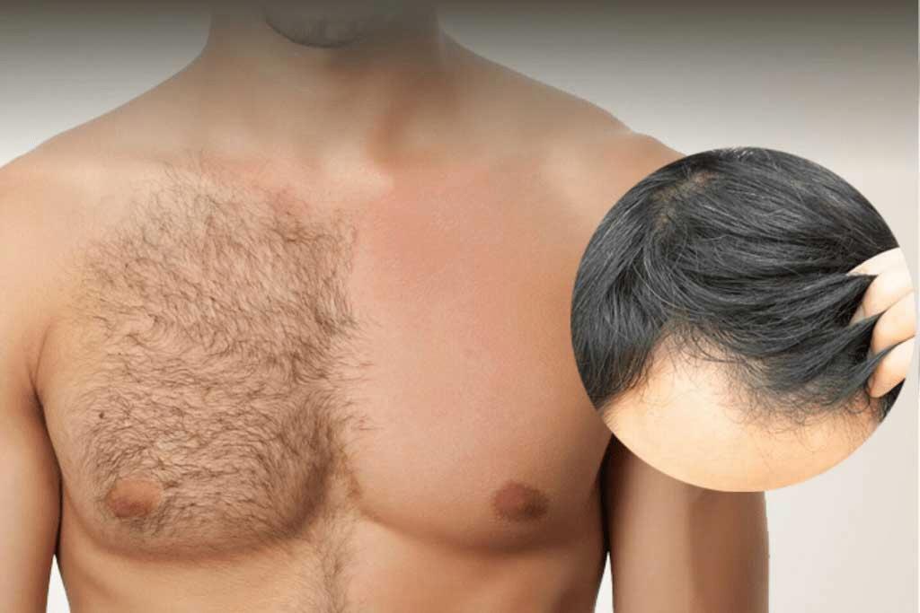 Body Hair Transplante Capilar no Leblon - Rio de Janeiro - RJ
